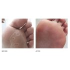 PEELING SKIN ÁPOLÓ HABFORMULA NYIRKOS, HÁMLÓ BŐRRE CLOTRIMAZOLE-LAL, 125ML